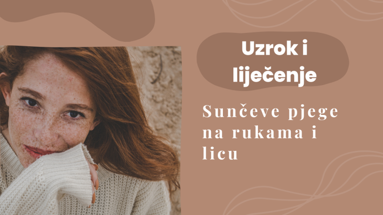 sunceve pjege na rukama i licu