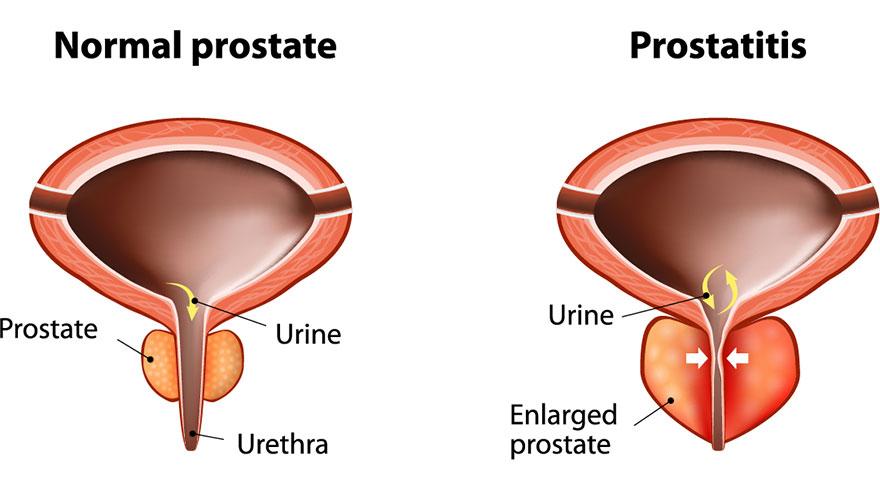 prostatitis simptomi